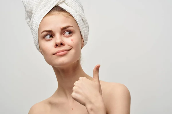 Mulheres em uma toalha e com espinhas em seu rosto gesticulando com as mãos acne pele limpa — Fotografia de Stock