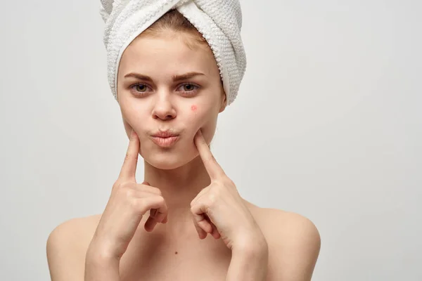 Mulheres em uma toalha e com espinhas em seu rosto gesticulando com as mãos acne pele limpa — Fotografia de Stock