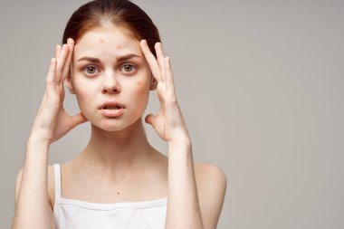 Kadın derisi sorunlu sivilcelerle boğuşuyor. Kesilmiş sivilceli portre. 