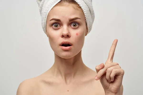 Mujer con toalla en la cabeza hombros desnudos piel transparente acné tratamientos de spa — Foto de Stock