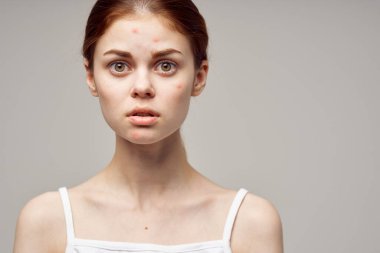 Kadın derisi sorunlu sivilcelerle boğuşuyor. Kesilmiş sivilceli portre. 