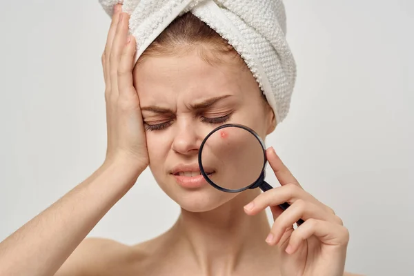 Mujer con acné en la cara sostiene una lupa y toalla de aspecto molesto en la cabeza —  Fotos de Stock