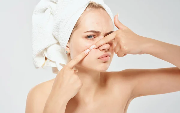 En kvinna med en handduk på huvudet klämmer ut akne i ansiktet problem hud kosmetologi dermatologi — Stockfoto