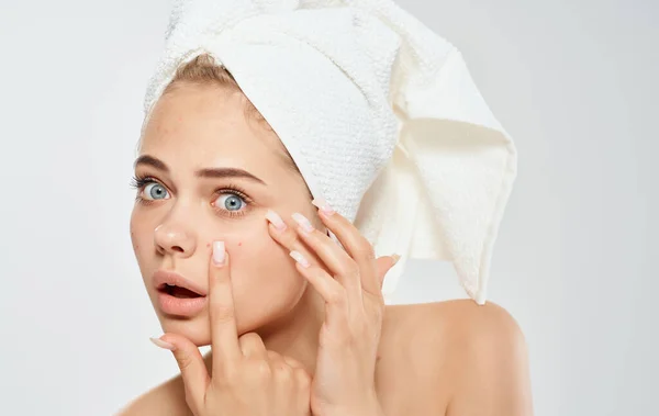 Seorang wanita dengan handuk di kepalanya meremas jerawat di wajah masalah kulit kosmetologi dermatologi — Stok Foto