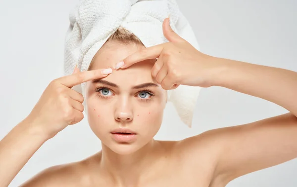 Kvinna och klämmer finnar på ansiktet problem hud med en handduk på huvudet bara axlar — Stockfoto