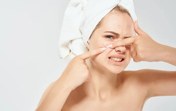 A woman with a towel on her head squeezes out acne on her face problem skin cosmetology dermatology — Stock Photo, Image