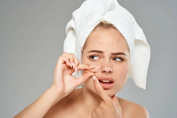 Mujer con una toalla en la cabeza acné en la cara dermatología cuidado de la piel —  Fotos de Stock