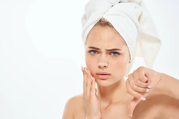 Kvinna med handduk bara axlar hudvård dermatologi problem — Stockfoto