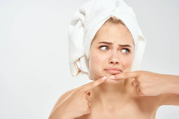 Жінка з рушником на голові стискає прищики на обличчі чисте здоров'я шкіри — стокове фото