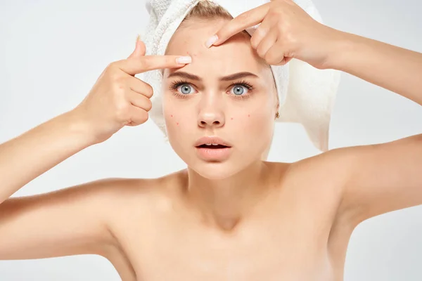 Жінка з голими плечима з рушником на голові дерматологія акне — стокове фото