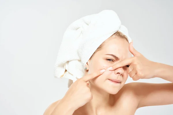 Mujer con hombros desnudos con una toalla en la cabeza exprime espinillas y dermatología higiene —  Fotos de Stock