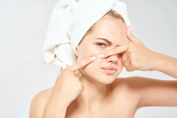 Mujer con hombros desnudos con una toalla en la cabeza dermatología del acné — Foto de Stock