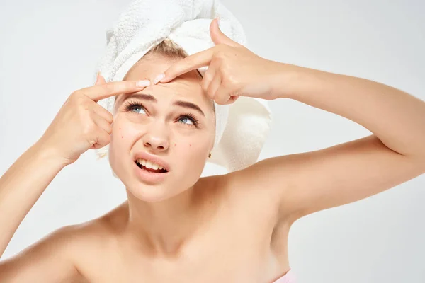 Mujer con hombros desnudos con una toalla en la cabeza exprime espinillas y dermatología higiene — Foto de Stock