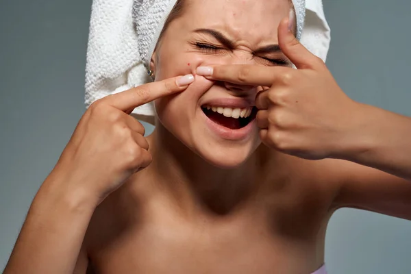 Mulher com uma toalha na cabeça aperta espinhas na testa problemas de pele — Fotografia de Stock