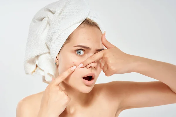 Mujer bonita con una toalla en la cabeza exprime granos en la cara problemas de cuidado de la piel — Foto de Stock