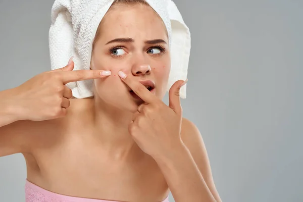 タオルを頭につけた可愛い女性は顔ににきびを絞り出します 高品質の写真 — ストック写真