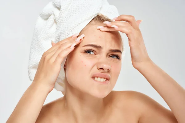 頭の上にタオルを持つ女性にきび皮膚科の不満皮膚の問題 — ストック写真