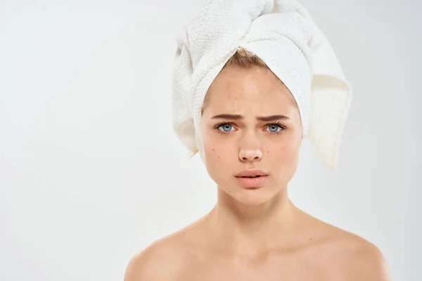 Wanita dengan handuk di kepala wajah masalah kulit dipotong tampilan — Stok Foto