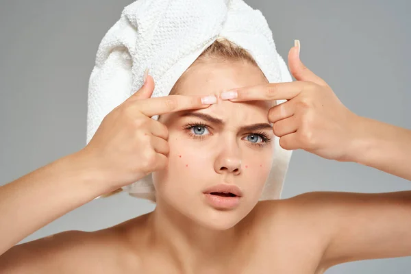 Vacker kvinna med handduk på huvudet hudvård dermatologi hygien — Stockfoto