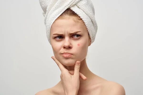 Mooie vrouw met een pukkel op het gezicht dermatologie geïsoleerde achtergrond — Stockfoto