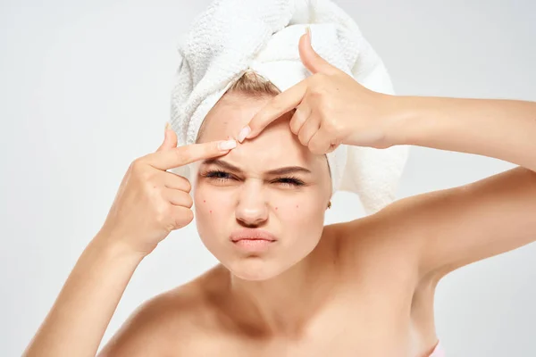 Jolie femme avec une serviette sur ma tête acné sur le visage dermatologie — Photo