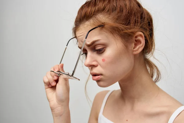 Жінка з прищами на обличчі гігієна лікування — стокове фото
