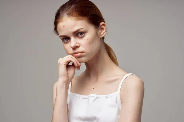 Mooie Vrouw Met Puistjes Het Gezicht Geïsoleerde Achtergrond Hoge Kwaliteit — Stockfoto