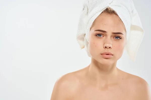 Kvinna med bara axlar finnar på ansiktet dermatologi missnöje känslor — Stockfoto
