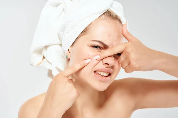 Mujer con hombros desnudos con una toalla en la cabeza exprime espinillas y dermatología higiene — Foto de Stock