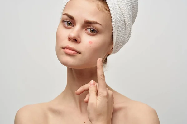 Beautiful woman with a pimple on the face cosmetology Studio — Stock Photo, Image
