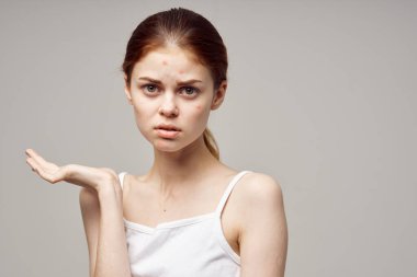 Yüzünde sivilceler olan güzel bir kadın.