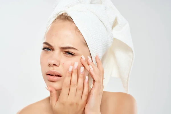 Nő törölköző a fej bőrápolás bőrgyógyászat elégedetlenség probléma — Stock Fotó