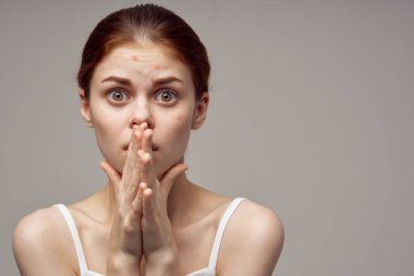 Beyaz tişörtlü güzel bir kadın. Yüzünde sivilceler.