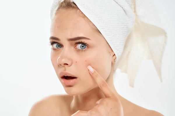 Hermosa mujer con una toalla en la cabeza acné en la dermatología facial descontento — Foto de Stock