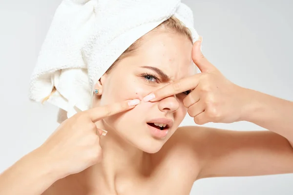 Mujer con una toalla en la cabeza acné en la dermatología facial — Foto de Stock