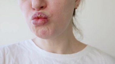 Uçuklardan etkilenen kız dudaklarına yakın çekim. Uçuk enfeksiyonu ve virüs tedavisi. Genç kadın yüzünün bir parçası, uçuklu dudaklar. Güzellik dermatolojisi konsepti
