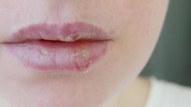 Uçuklardan etkilenen kız dudaklarına yakın çekim. Uçuk enfeksiyonu ve virüs tedavisi. Genç kadın yüzünün bir parçası, uçuklu dudaklar. Güzellik dermatolojisi konsepti