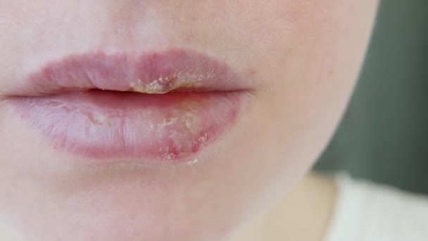 Close Van Meisjes Lippen Getroffen Door Herpes Behandeling Van Herpes — Stockvideo
