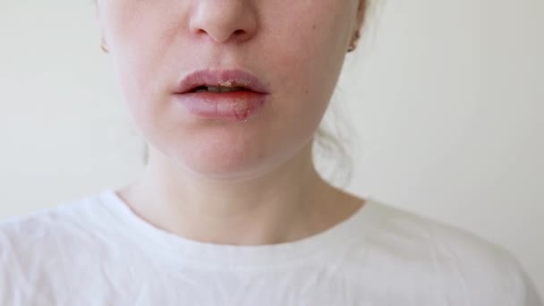 Detailní Záběr Dívčích Rtů Postižených Herpes Léčba Herpes Infekce Viru — Stock video