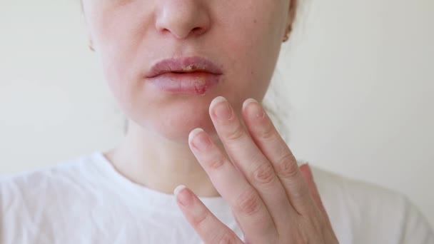 Close-up van meisjes lippen getroffen door herpes. Behandeling van herpes infectie en virus. Een deel van de jonge vrouw gezicht met vinger aanraken pijn op de lippen met herpes aangetast. Schoonheidsdermatologisch concept. — Stockvideo