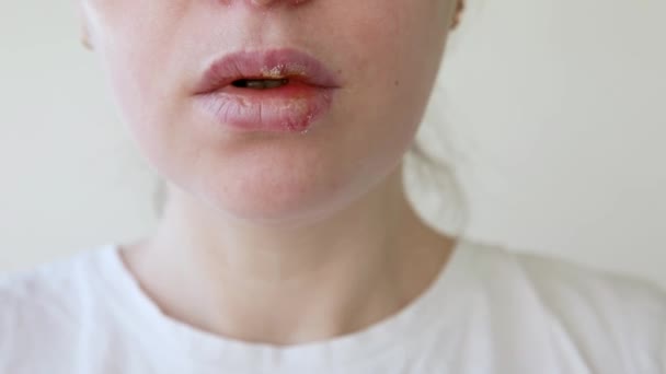 Menutup bibir gadis dipengaruhi oleh herpes. Pengobatan infeksi herpes dan virus. Bagian dari wajah wanita muda, bibir dengan herpes terpengaruh. Konsep dermatologi kecantikan. — Stok Video