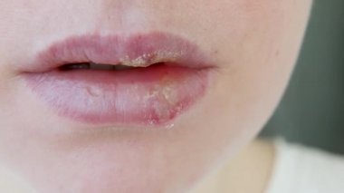 Uçuklardan etkilenen kız dudaklarına yakın çekim. Uçuk enfeksiyonu ve virüs tedavisi. Genç kadın yüzünün bir parçası, uçuklu dudaklar. Güzellik dermatolojisi konsepti