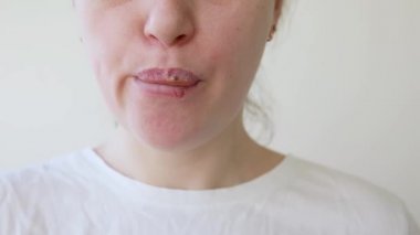 Uçuklardan etkilenen kız dudaklarına yakın çekim. Uçuk enfeksiyonu ve virüs tedavisi. Genç kadın yüzünün bir parçası, uçuklu dudaklar. Güzellik dermatolojisi konsepti