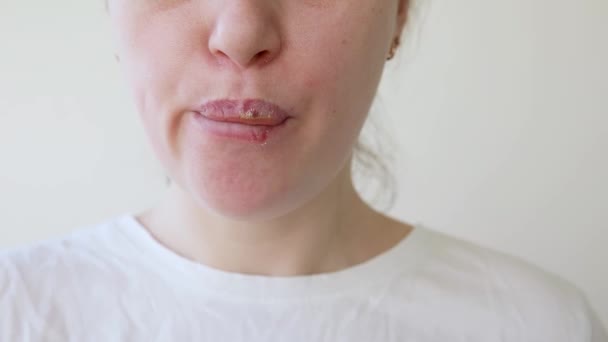 Close Van Meisjes Lippen Getroffen Door Herpes Behandeling Van Herpes — Stockvideo