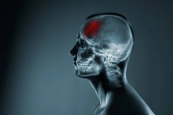 X-ray of a mans head. Medical examination of head injuries. Frontal part of the brain is highlighted by red colour. — Stock Photo, Image