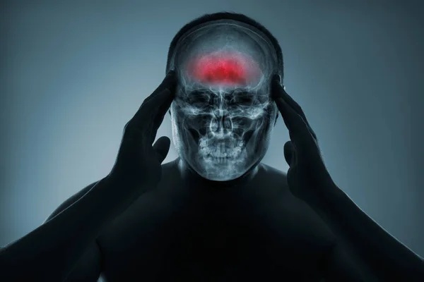 머리의 엑스레이요 부상에 의학적 뇌출혈이야 앞부분 부분은 빨간색으로 강조되어 포트폴리오에 — 스톡 사진