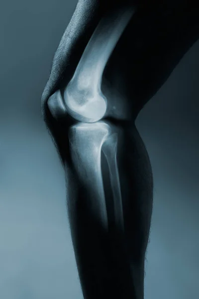 Human knee joint and leg in x-ray, on gray background.