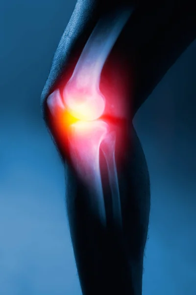 Людський колінний суглоб і нога на рентгенівському фоні — стокове фото