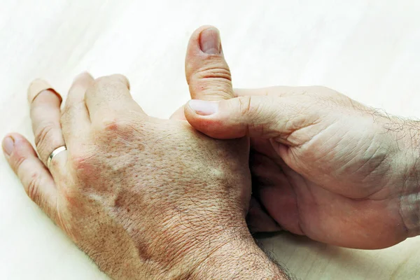 Man Has Pain Her Hands Fingers Suffers Dry Skin — Stock Photo, Image