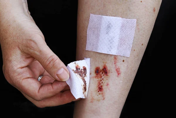 Una Mujer Tiene Una Herida Sangrante Pierna — Foto de Stock
